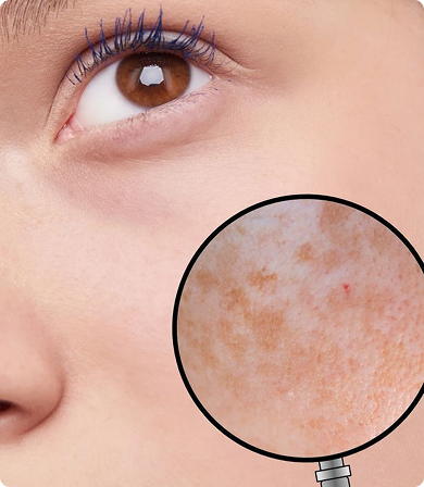FOR DARKSPOTS